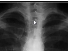 Chest x-ray, Right Paratracheal stripe Chest x-ray, Right Paratracheal stripe