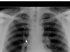 Chest x-ray, right sided aortic arch Chest x-ray, right sided aortic arch