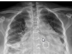 Chest x-ray, segmental collapse Chest x-ray, segmental collapse