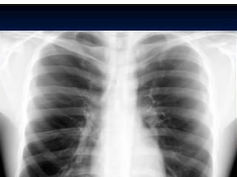 Chest x-ray --Silhouette Sign Chest x-ray --Silhouette Sign
