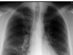 chest x-ray, subsegmental atelectasis chest x-ray, subsegmental atelectasis
