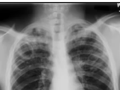 Chest x-ray - Tuberculosis Chest x-ray - Tuberculosis