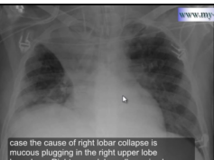 Chest xray - Pneumonia, tumor or something else Chest xray - Pneumonia, tumor or something else
