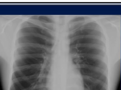 Chest xray, Respiratory system, Pneumonia, consolidation Chest xray, Respiratory system, Pneumonia, consolidation
