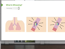 Childhood Asthma: Pathology, Signs & Symptoms - Pediatric Pulmonology