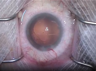 Chirurgie de la cataracte - implant Miniwell Ready Chirurgie de la cataracte - implant Miniwell Ready