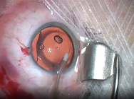 Chirurgie implant phake myopique ICL