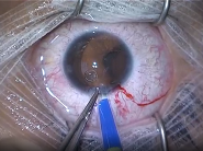 Chirurgie iris artificiel - HumanOptics Chirurgie iris artificiel - HumanOptics