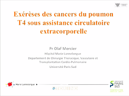 Chirurgie maximalement invasive: exérèses pulmonaires sous circulation extracorporelle. Chirurgie maximalement invasive: exérèses pulmonaires sous circulation extracorporelle.