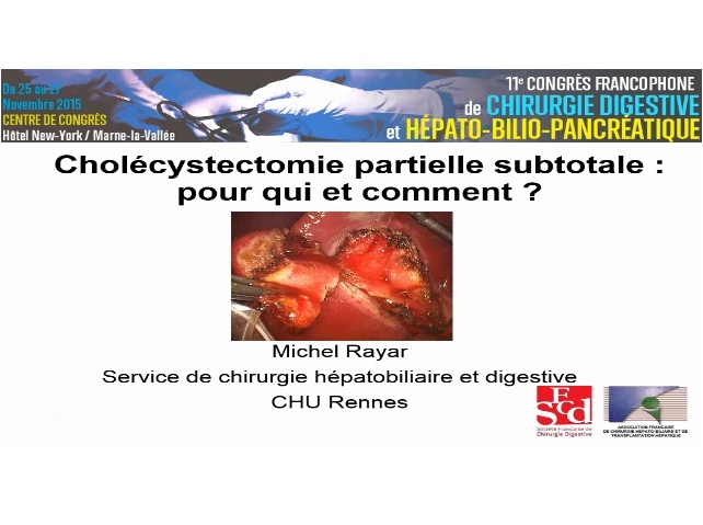Cholecystectomie partielle subtotale : pour qui et comment ?