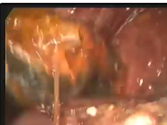 Choledochal Endoscopic Basket Removal And Choledochoduodenostomy Performed By Videolaparoscopy - Cas Choledochal Endoscopic Basket Removal And Choledochoduodenostomy Performed By Videolaparoscopy - Cas