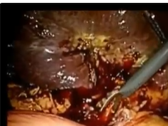 Choledochotomy Lcbde, Cholangitis, Large Stone