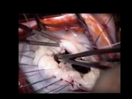 Chordal relocation for repair of anterior mitral leaflet flail: A reproducible option Chordal relocation for repair of anterior mitral leaflet flail: A reproducible option