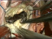 Chordal replacement in mitral repair