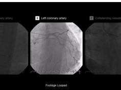 Chronic Thromboembolic Pulmonary Hypertension (CTEPH) Coronary-to-Pulmonary Artery Collateralization Chronic Thromboembolic Pulmonary Hypertension (CTEPH) Coronary-to-Pulmonary Artery Collateralization