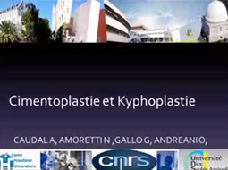 Cimentoplastie et kyphoplastie Cimentoplastie et kyphoplastie