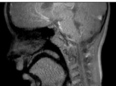 Cine Magnetic Resonance Imaging With Simultaneous Audio to Evaluate Pediatric Velopharyngeal Insuffi Cine Magnetic Resonance Imaging With Simultaneous Audio to Evaluate Pediatric Velopharyngeal Insuffi