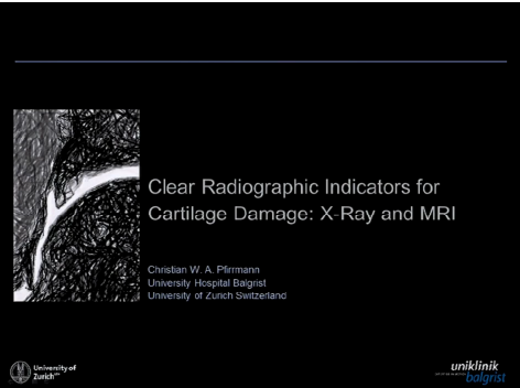 Clear radiographic indicators for cartilage damage: X-ray & MRI