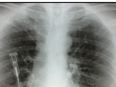Clinical Case: Pulmonary Abscess