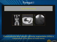 Clinical outcome after magnetic sphincter augmentation (MSA) is independent of the status Clinical outcome after magnetic sphincter augmentation (MSA) is independent of the status