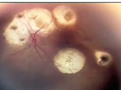 Clinical Reperfusion of Retinal Vasculature Clinical Reperfusion of Retinal Vasculature