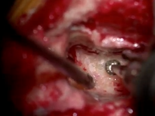 Cochlear Implantation in Patient with High-Riding Jugular Bulb