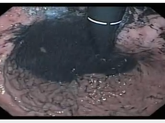 Coffee Grounds after Upper GI Bleeding