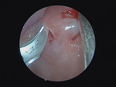 Cold Steel Tonsillectomy