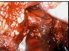 Colon Resection: When Does the Hand Help? Colon Resection: When Does the Hand Help?