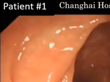 Colonoscopic diagnosis of rectal endometriosis without obvious or exact mucosa-infiltrated signs Colonoscopic diagnosis of rectal endometriosis without obvious or exact mucosa-infiltrated signs