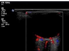 Color Doppler Imaging of the Normal Optic Nerve Color Doppler Imaging of the Normal Optic Nerve