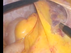 Colorectal Anastomosis after Laparoscopic Extended Left Colectomy: Techniques and Outcome Colorectal Anastomosis after Laparoscopic Extended Left Colectomy: Techniques and Outcome