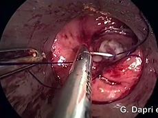 Colorectal Anastomotic Leaks Corrected By Transanal Laparoscopy