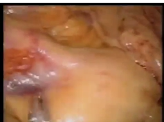 Colorectal Surgery with Single Port: Feza Remzi, M.D. Colorectal Surgery with Single Port: Feza Remzi, M.D.