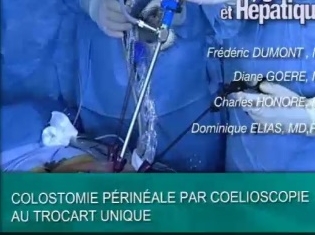 Colostomie périnéale par coelioscopie Colostomie périnéale par coelioscopie