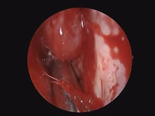 Combined Endoscopic and Open Craniofacial Resection for Esthesioneuroblastoma