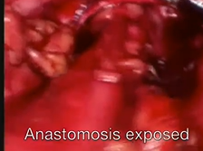 Combined Laparoscopic and Transanal Minimally Invasive Management of an Anastomotic Stricture Combined Laparoscopic and Transanal Minimally Invasive Management of an Anastomotic Stricture