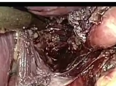 Combined Thoracoscopic And Laparoscopic Transhiatal Esophagectomy For Esophageal Cancer Combined Thoracoscopic And Laparoscopic Transhiatal Esophagectomy For Esophageal Cancer