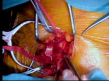 Common Femoral Artery Aneurysm Repair Common Femoral Artery Aneurysm Repair