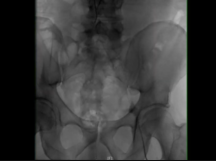 Common Femoral Vein to Inferior Vena Cava Bypass Common Femoral Vein to Inferior Vena Cava Bypass