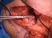 Complete demonstration of the radial artery forearm phalloplasty formation