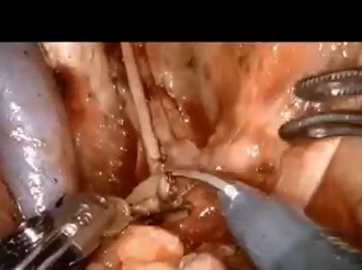 Complete Robotic Lateral Pelvic Node Dissection Using DaVinci Xi Platform In Rectal Cancer Complete Robotic Lateral Pelvic Node Dissection Using DaVinci Xi Platform In Rectal Cancer