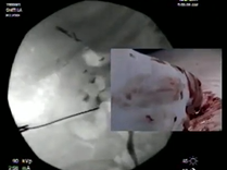 Complications of Percutaneous Access during Percutaneous Nephrolithotomy