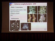 Conduite à tenir devant une douleur au poignet après un traumatisme en hyper extension Conduite à tenir devant une douleur au poignet après un traumatisme en hyper extension
