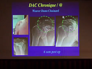 Conduites à tenir devant une disjonction acromioclaviculaire