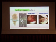 Conduites à tenir devant une instabilité postérieure de lépaule