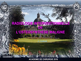 Consolidation percutanée dans l'ostéolyse maligne