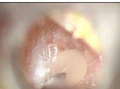Contribution of External Ear Bacterial Reservoirs To Otitis Media With Effusion Contribution of External Ear Bacterial Reservoirs To Otitis Media With Effusion