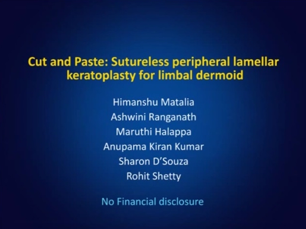 Cornée, Pathologies externes - Couper et Coller : kératoplastie lamellaire périphérique sans suture pour dermoïde limbique Cornée, Pathologies externes - Couper et Coller : kératoplastie lamellaire périphérique sans suture pour dermoïde limbique
