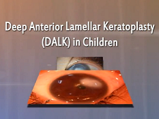 Cornée, Pathologies Externes - Kératoplastie lamellaire profonde antérieure : sélection du patient, techniques et résultats Cornée, Pathologies Externes - Kératoplastie lamellaire profonde antérieure : sélection du patient, techniques et résultats